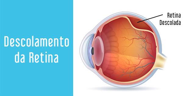 Descolamento da Retina  Oculari Hospital Oftalmológico